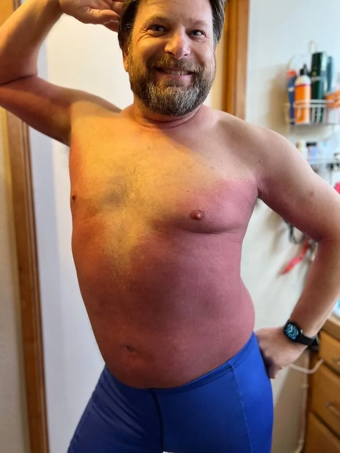 Man with extensive sunburn on torso posing in a home setting illustrating medical posts about unusual skin conditions.