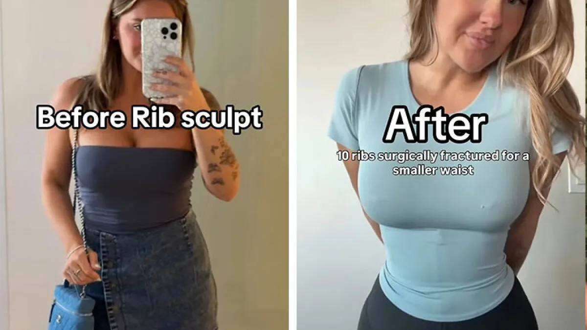 Mom Who Got Her Ribs Broken To Make Waist 'Smaller' Reveals Transformation In Before-And-After Clips