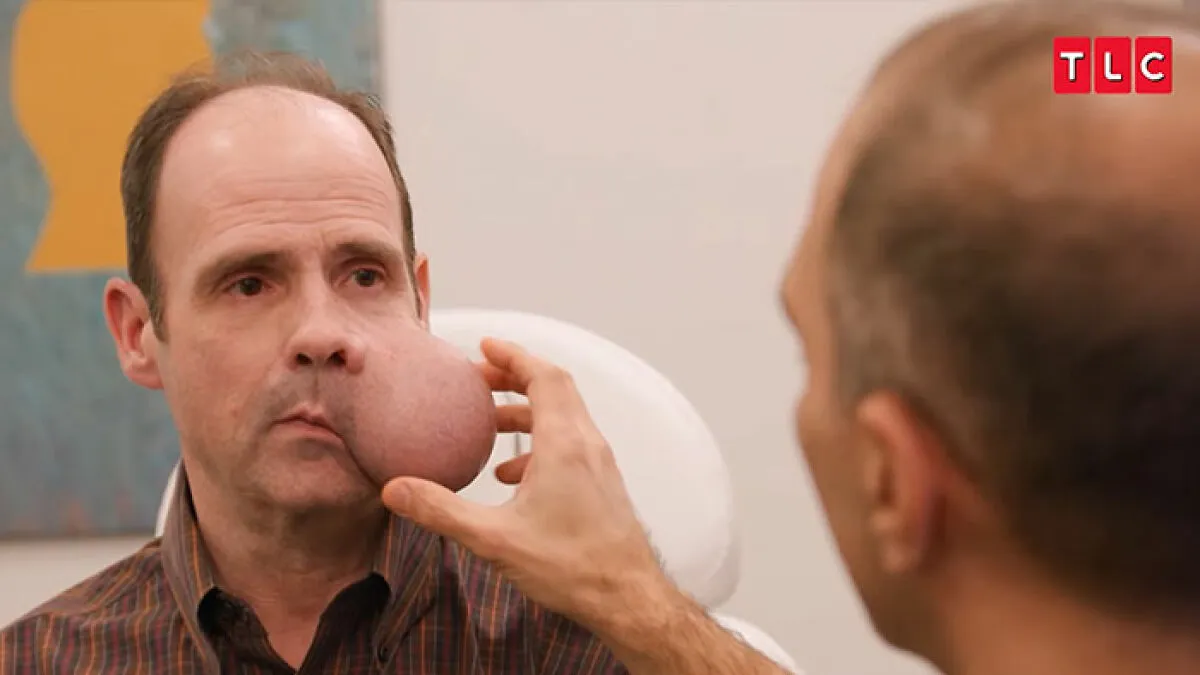 After Man Waits 7 Years To Remove 4-Lb. Face Tumor, Doctor Gives Him Fatal Warning