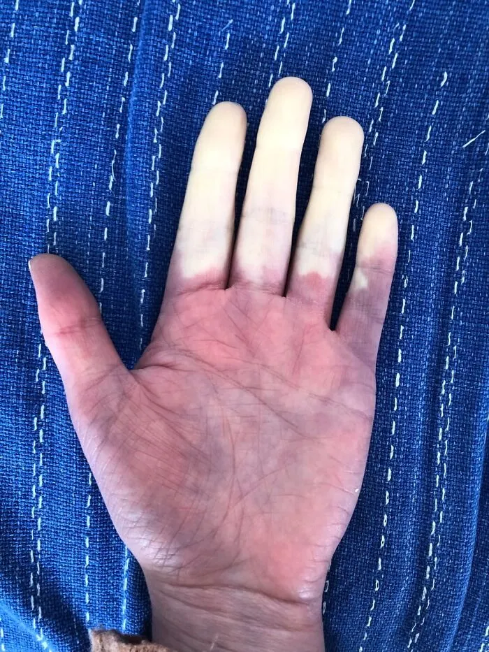 El médico me dijo que mi síndrome de Raynaud debería estar en un libro de texto de medicina.