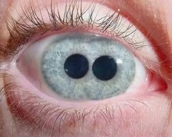 Close-up of a human eye with two black pupils, showcasing a deeply unsettling medical anomaly.