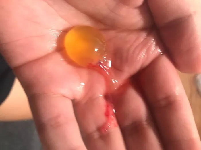 Esto salió de la nariz de mi novia y lo tosió, ¿qué es esto?