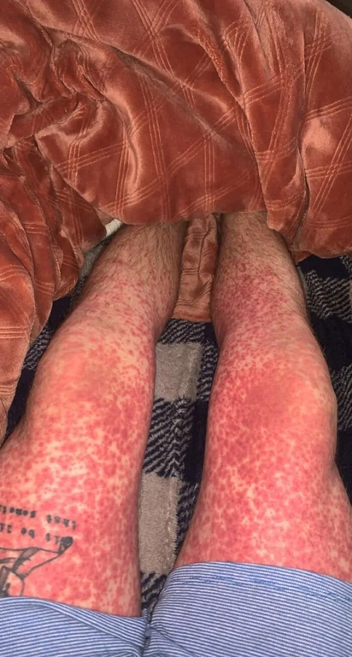 Sarpullido horrible que me salió por tomar antibióticos para la mononucleosis.
