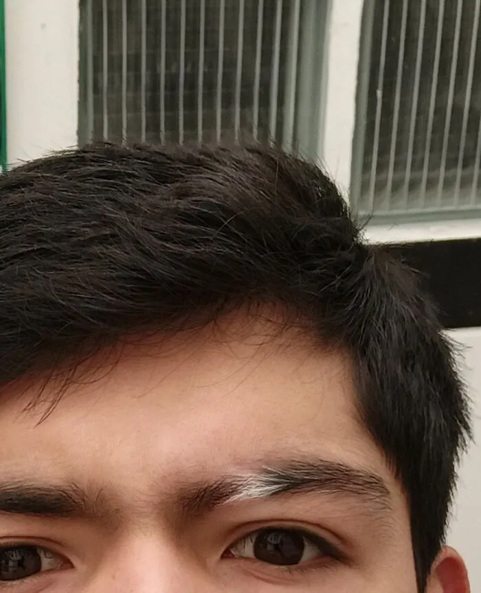 Close-up of a person's eyes and forehead showing a white patch of hair, illustrating a unique medical condition.