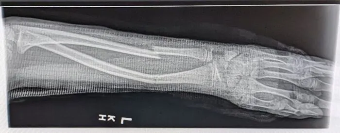 Mi hija de 9 años se rompió el brazo. El médico dijo que sanará bien. ¿Debería buscar una segunda opinión?