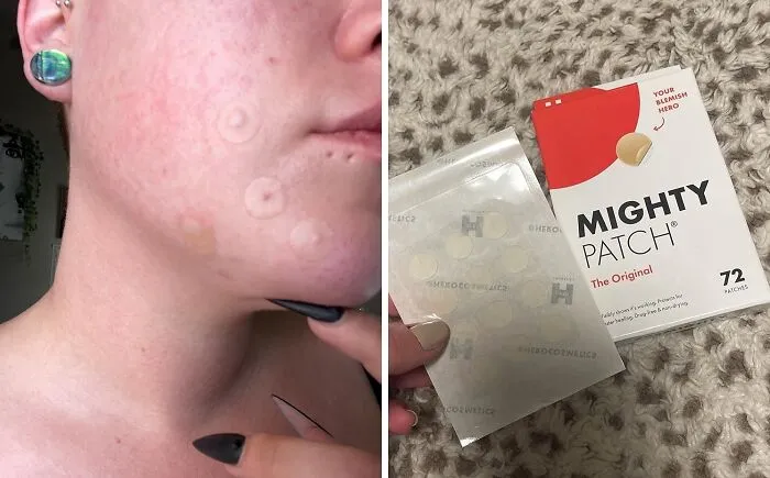 Stop That Angry Zit From Becoming The Main Character Of Your Face With A Strategically Placed <a Style="Display:inline;" Href="Https://Www.amazon.com/Dp/B07b4kqvk6?ascsubtag=7633336%2c12%2c34%2cd%2c0%2c0%2cbf-Web-Hf%2c900%3a2%3b974%3a2%3b1125%3a1%2c44097437%2c0%2c0%2cgoogle&th=1&linkcode=ll1&tag=bpfrog-20&linkid=777ad5c34082eabe33af6e2d6b84e23c&language=en_us&ref_=as_li_ss_tl" Target="_blank">  <span Style="Font: Inherit; Color: #d74b1f;"> Mighty Patch </Span>