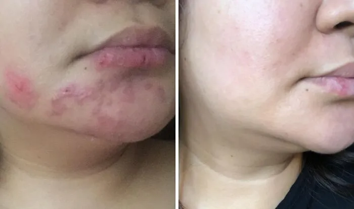  Prevent Your Skin From Entering Its Ancient Mummy Era This Winter With The Help Of This <a Style="Display:inline;" Href="Https://Www.amazon.com/Bio-Oil-4-2oz-Multiuse-Skincare-Oil/Dp/B004ai97ma?ie=utf8&th=1&linkcode=ll1&tag=bpfrog-20&linkid=d4488a9257aa5a14a0428d29d3585e18&language=en_us&ref_=as_li_ss_tl" Target="_blank">  <span Style="Font: Inherit; Color: #d74b1f;"> Bio-Oil Skincare Body Oil </Span>