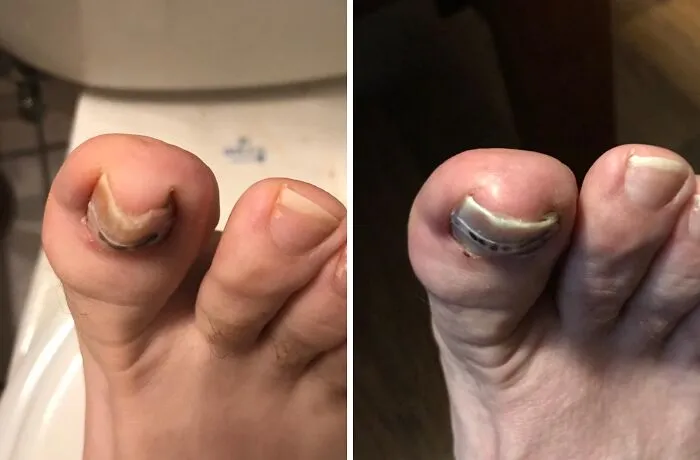 Declare A Ceasefire In The War Your Big Toe Is Waging Against Your Skin With This <a Style="Display:inline;" Href="Https://Www.amazon.com/Curvecorrect-Ingrown-Treatment-Correction-Standard/Dp/B007oyke6a?ie=utf8&linkcode=ll1&tag=bpfrog-20&linkid=2f898e874bc4a0def615d8e8b93d9a76&language=en_us&ref_=as_li_ss_tl" Target="_blank">  <span Style="Font: Inherit; Color: #d74b1f;"> Ingrown Toenail Treatment Kit </Span