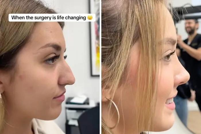 People Are Sharing What They Look Like After Plastic Surgery And Here Are 30 Examples