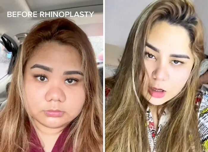 People Are Sharing What They Look Like After Plastic Surgery And Here Are 30 Examples