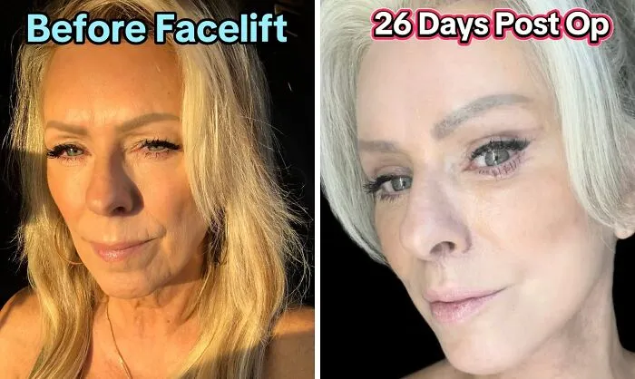 People Are Sharing What They Look Like After Plastic Surgery And Here Are 30 Examples