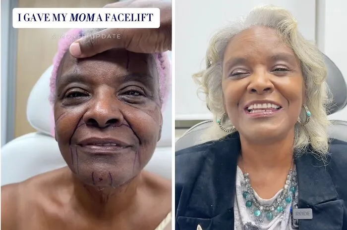 People Are Sharing What They Look Like After Plastic Surgery And Here Are 30 Examples
