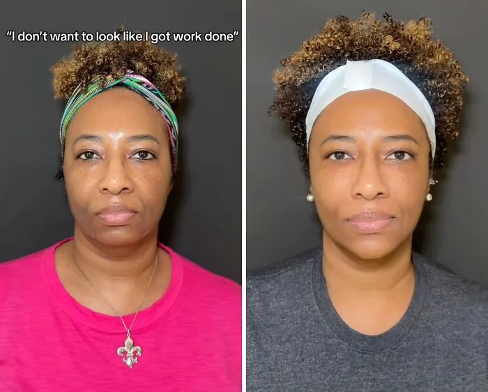 People Are Sharing What They Look Like After Plastic Surgery And Here Are 30 Examples