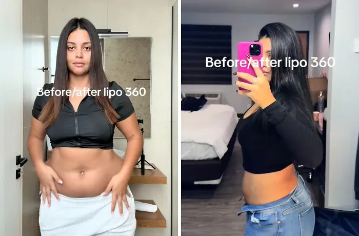 People Are Sharing What They Look Like After Plastic Surgery And Here Are 30 Examples
