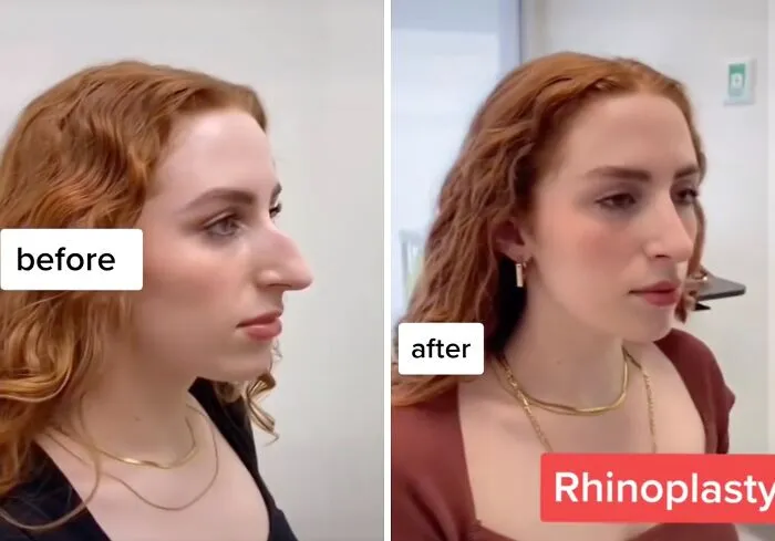 People Are Sharing What They Look Like After Plastic Surgery And Here Are 30 Examples