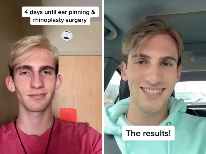 People Are Sharing What They Look Like After Plastic Surgery And Here Are 30 Examples