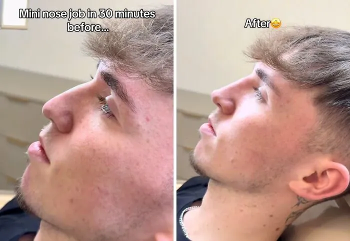 People Are Sharing What They Look Like After Plastic Surgery And Here Are 30 Examples