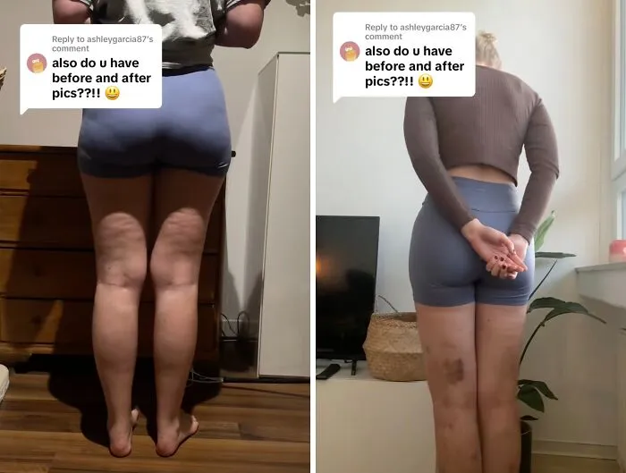 People Are Sharing What They Look Like After Plastic Surgery And Here Are 30 Examples
