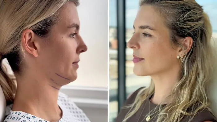 People Are Sharing What They Look Like After Plastic Surgery And Here Are 30 Examples