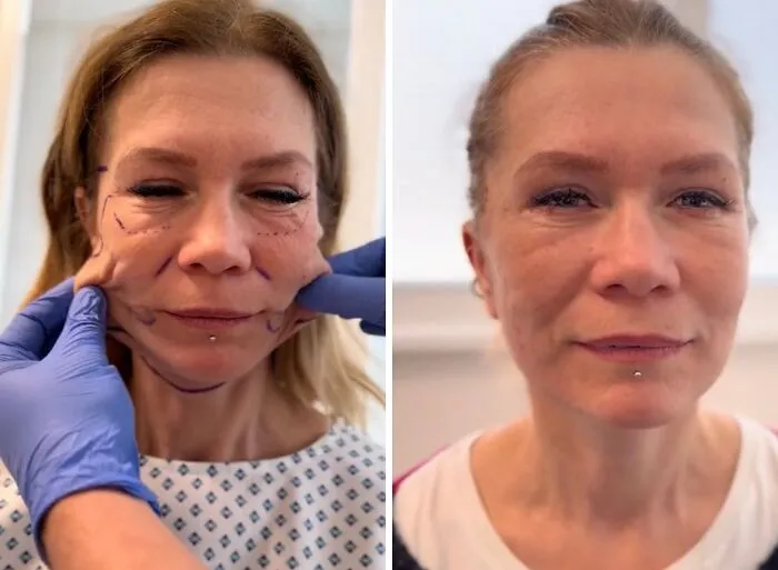 People Are Sharing What They Look Like After Plastic Surgery And Here Are 30 Examples
