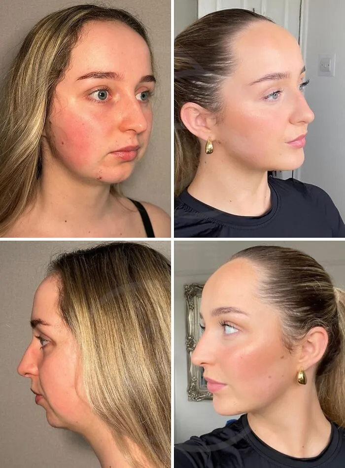 “Turning Back Time”: 50 Incredible Transformations From People Who Went Under The Knife To Change How They Look