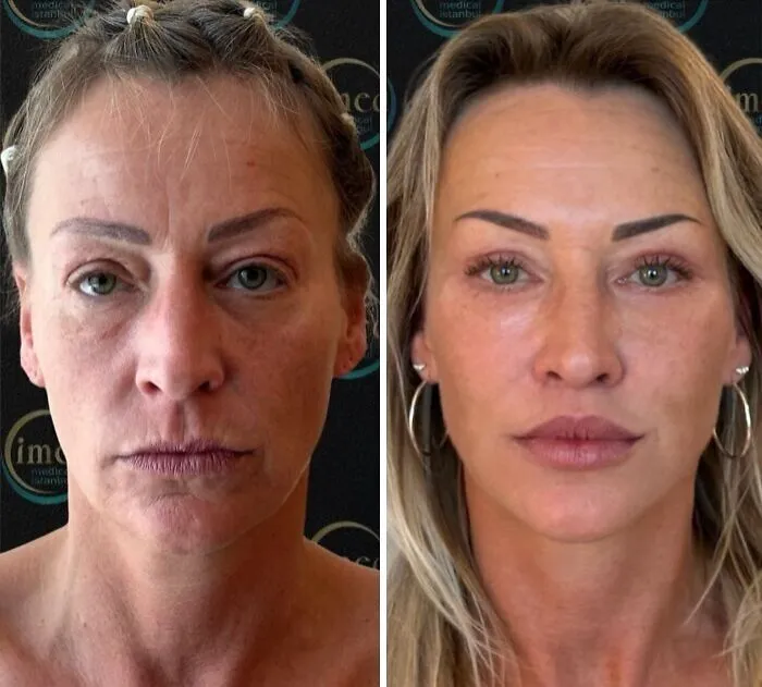 “Turning Back Time”: 50 Incredible Transformations From People Who Went Under The Knife To Change How They Look