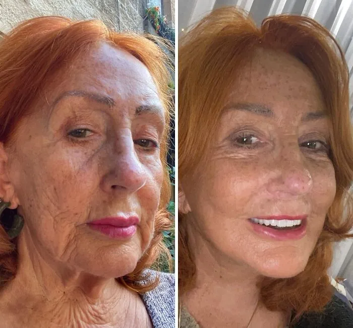 “Turning Back Time”: 50 Incredible Transformations From People Who Went Under The Knife To Change How They Look