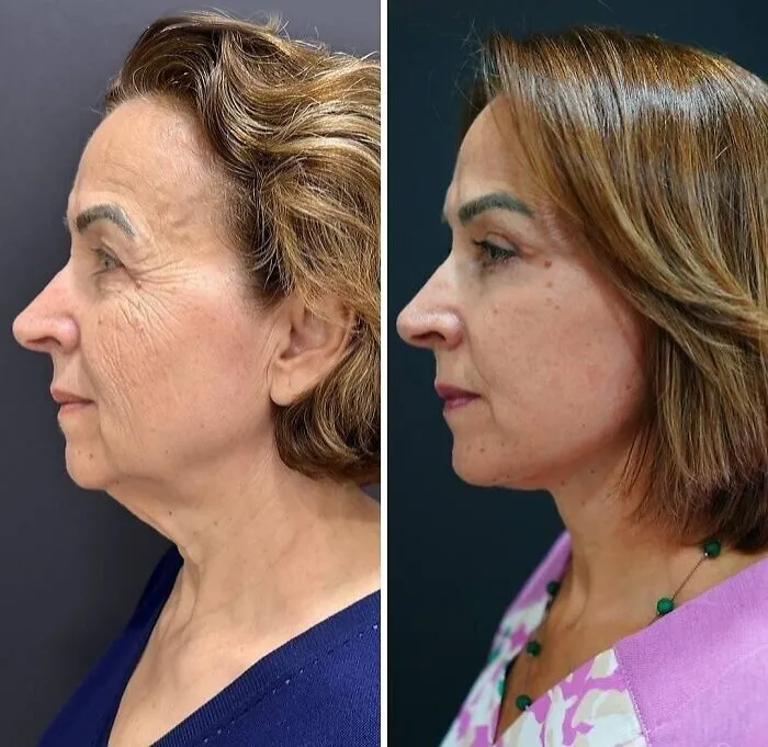 “Turning Back Time”: 50 Incredible Transformations From People Who Went Under The Knife To Change How They Look