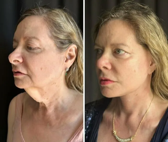 “Turning Back Time”: 50 Incredible Transformations From People Who Went Under The Knife To Change How They Look