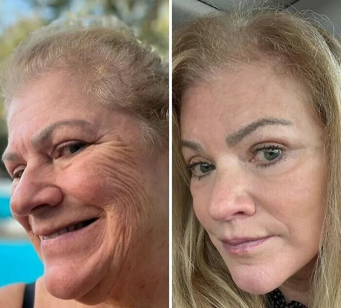 “Turning Back Time”: 50 Incredible Transformations From People Who Went Under The Knife To Change How They Look