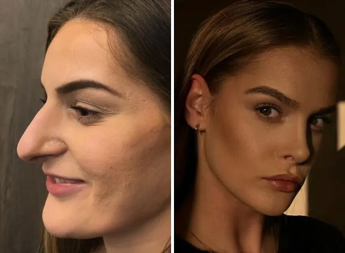 “Turning Back Time”: 50 Incredible Transformations From People Who Went Under The Knife To Change How They Look