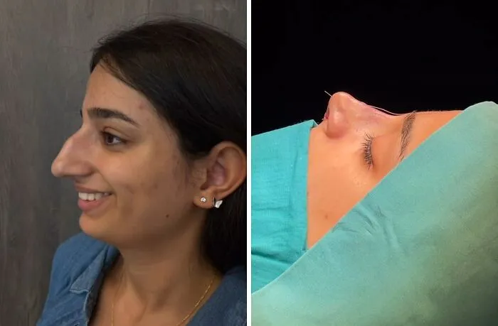 “Turning Back Time”: 50 Incredible Transformations From People Who Went Under The Knife To Change How They Look