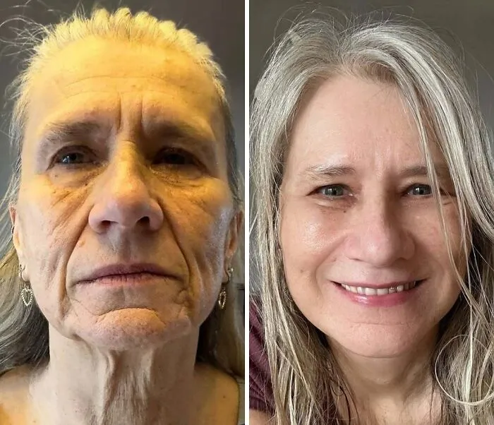 “Turning Back Time”: 50 Incredible Transformations From People Who Went Under The Knife To Change How They Look