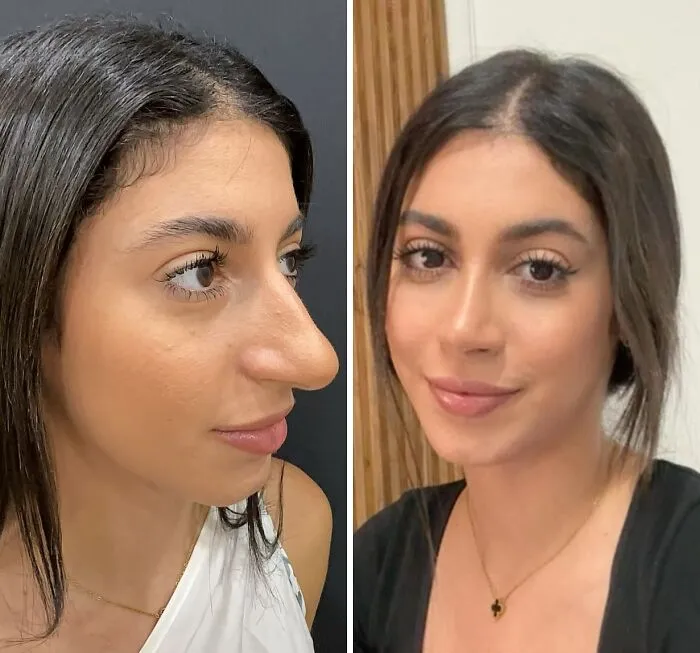 “Turning Back Time”: 50 Incredible Transformations From People Who Went Under The Knife To Change How They Look
