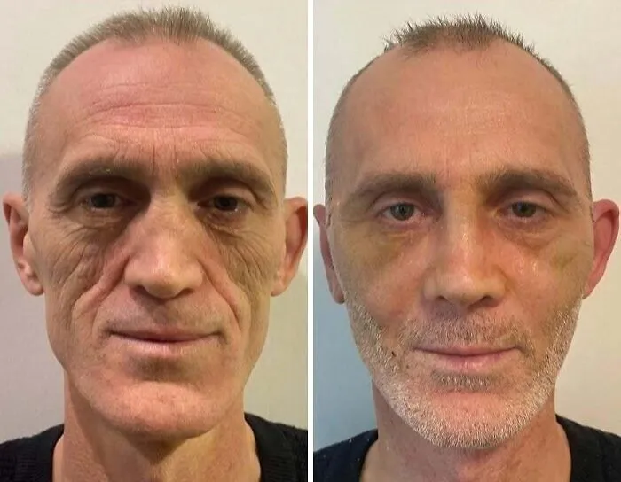 “Turning Back Time”: 50 Incredible Transformations From People Who Went Under The Knife To Change How They Look