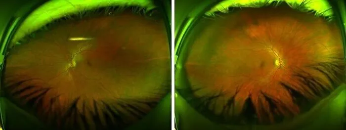 Close-up pictures showing detailed insides of a human eye with vibrant colors and intricate vein patterns.