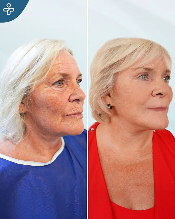 “Turning Back Time”: 50 Incredible Transformations From People Who Went Under The Knife To Change How They Look
