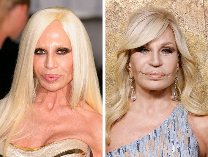 Beware of buzzwords like “mini” or “micro” facelifts, because they don’t exist