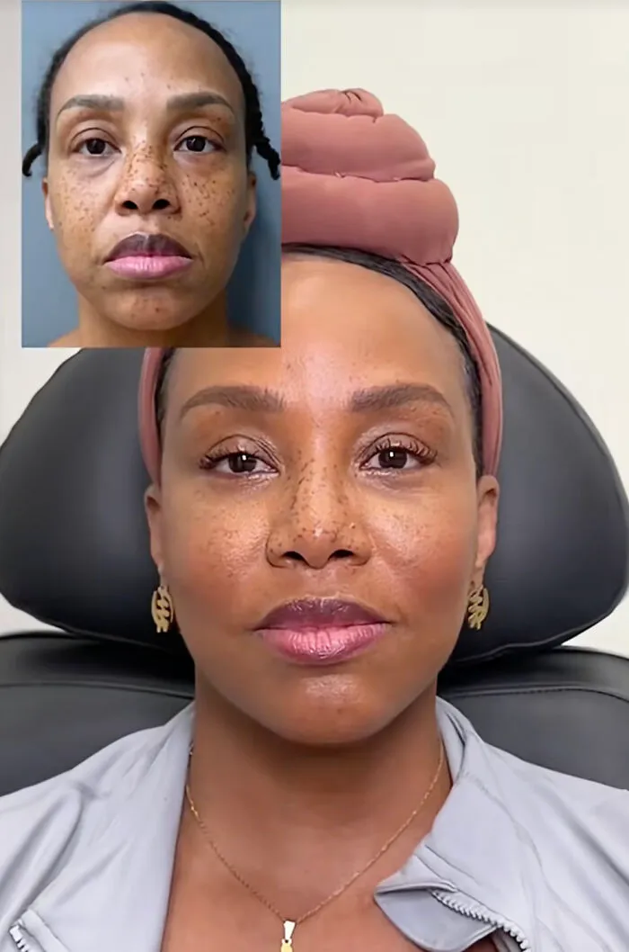 People Are Sharing What They Look Like After Plastic Surgery And Here Are 30 Examples