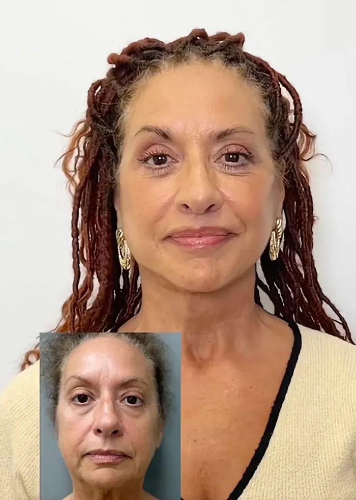 People Are Sharing What They Look Like After Plastic Surgery And Here Are 30 Examples