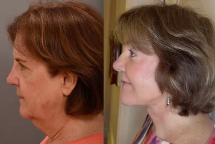 People Are Sharing What They Look Like After Plastic Surgery And Here Are 30 Examples