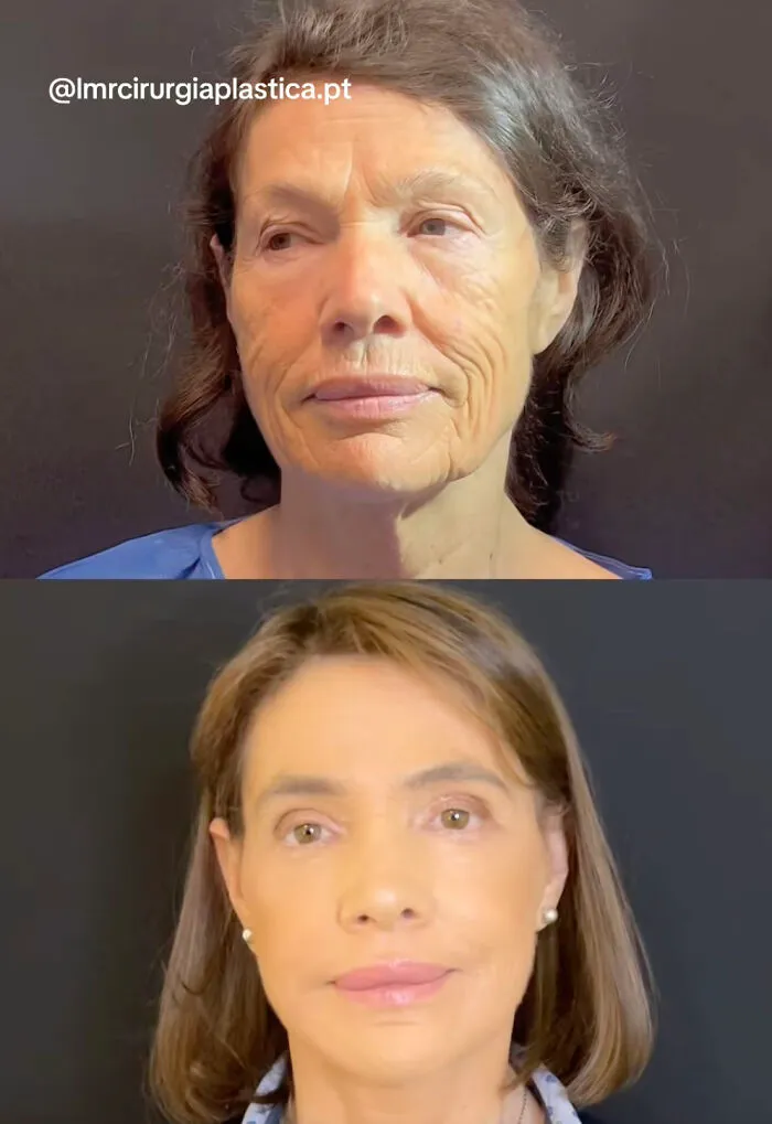 People Are Sharing What They Look Like After Plastic Surgery And Here Are 30 Examples