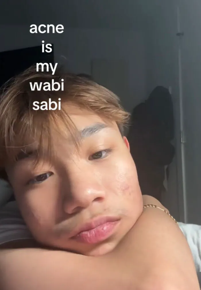 Young man with acne proudly embracing his perfect imperfections, highlighting the wholesome trend of self-acceptance.