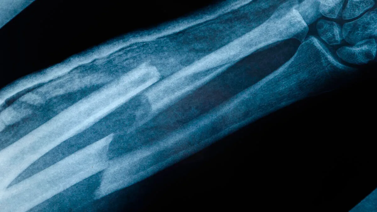 Broken Bone Theory: The TikTok Trend Making Superstition Weirdly Hilarious
