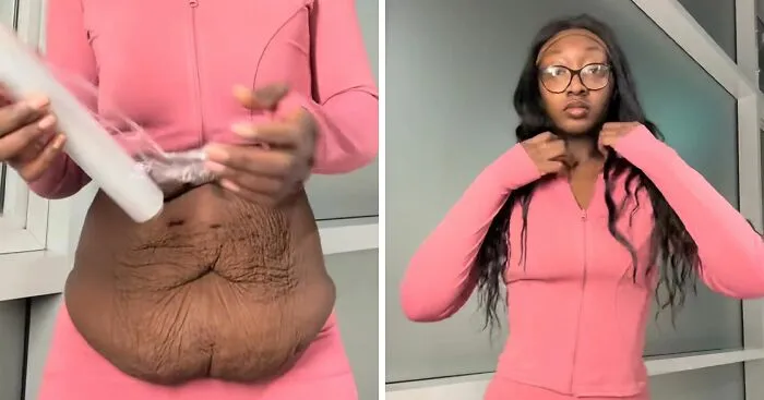 Woman's Trick To Hide Loose Skin On Her Belly After Massive Weight Loss Stuns People