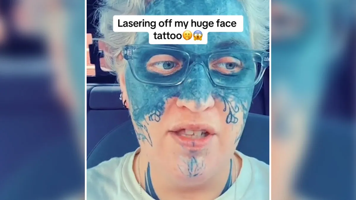 Brave Woman Shares Story Of Removing Unwanted Face Tattoo After Cruel Prank