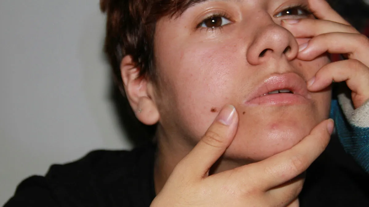 Mom Rages After Ex Removes Son’s Moles Without Telling Her, Says It Was "Cosmetic Surgery"