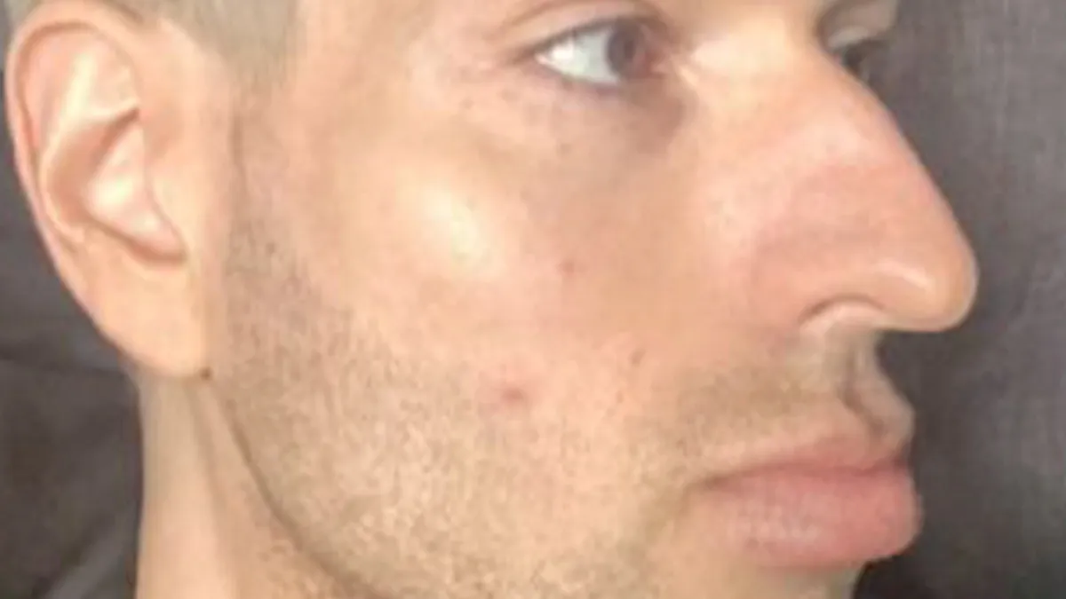 People Are Sharing What They Look Like After Plastic Surgery And Here Are 30 Examples