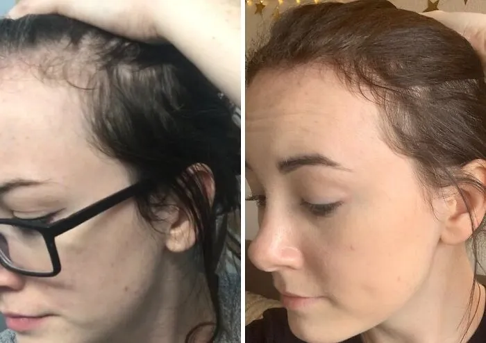Styling A Precarious Comb-Over To Hide Your Scalp Is Stressful Work That You Can Avoid By Using The <a Style="Display:inline;" Href="Https://Www.amazon.com/Biotin-Hair-Shampoo-Thinning-Moisturizing/Dp/B01encboa0?ie=utf8&th=1&linkcode=ll1&tag=bppelican-20&linkid=978681c6dcda54986754861fccf4b512&language=en_us&ref_=as_li_ss_tl" Target="_blank"> <span Style="Font: Inherit; Color: #d74b1f;"> Rosemary And Biotin Shampoo For Thinning Hair </Span> To Convince Your Follicles To Stick Around A Little Longer