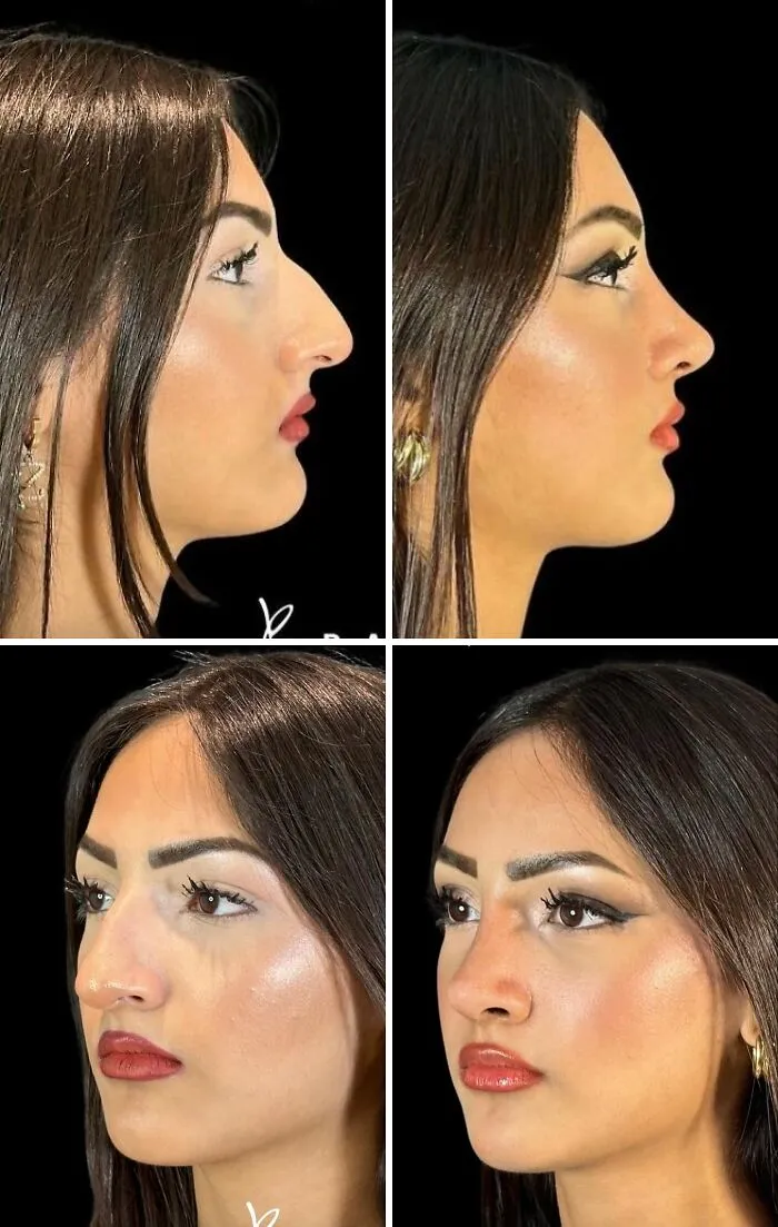 “Turning Back Time”: 50 Incredible Transformations From People Who Went Under The Knife To Change How They Look